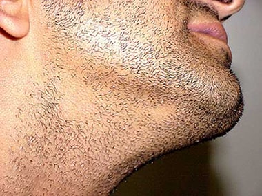 درمان ریزش ریش با روش های خانگی و دارویی موثر