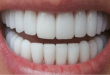 آیا کامپوزیت دندان روکش شده امکان پذیر است؟
