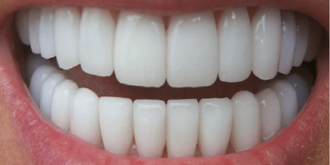 آیا کامپوزیت دندان روکش شده امکان پذیر است؟