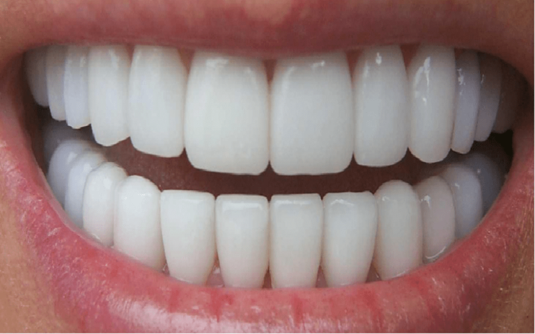  آیا کامپوزیت دندان روکش شده امکان پذیر است؟ 