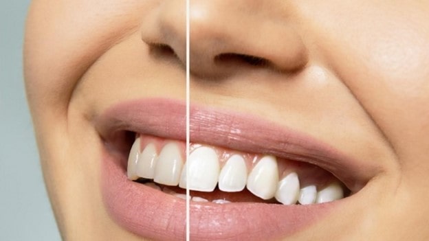  آیا کامپوزیت دندان روکش شده امکان پذیر است؟ 