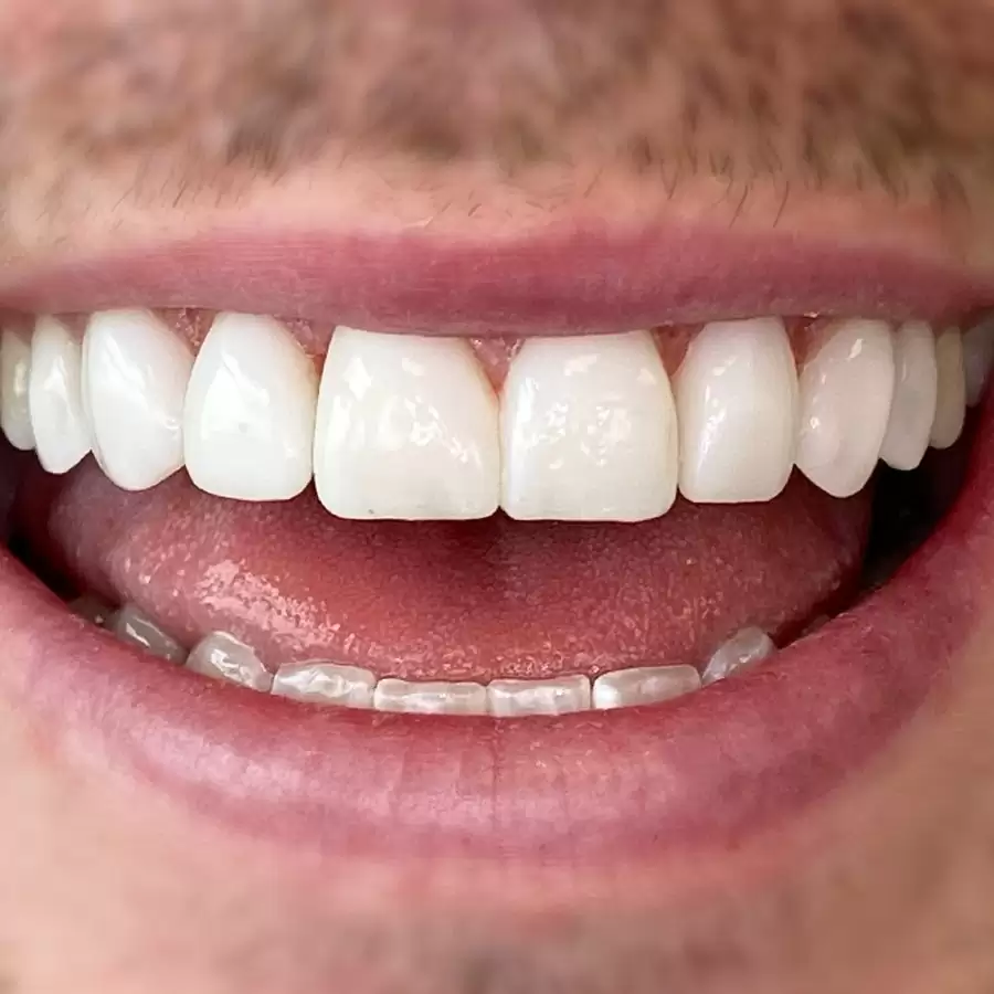 تاثیر کامپوزیت و لمینت بر زیبایی و سلامت دندان&zwnj;ها